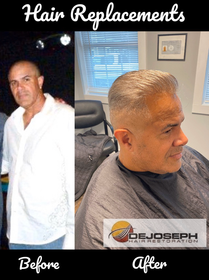 DeJoseph Hair Restoration | 577 Pearse Rd, Schenectady, NY 12309, USA | Phone: (518) 869-9543