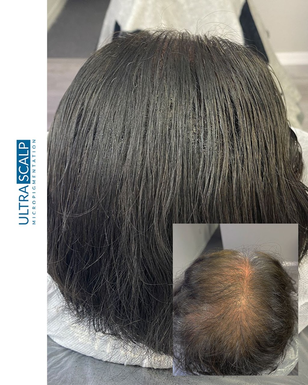 Ultra Scalp Micropigmentation | 4971 Van Dyke Rd, Lutz, FL 33558, USA | Phone: (813) 906-8696