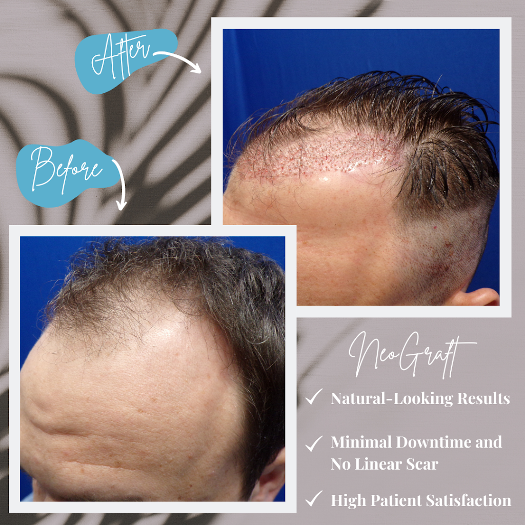 FUE Hair Transplant Solution New Jersey | 4057 Asbury Ave Suite 021, Tinton Falls, NJ 07753, USA | Phone: (848) 420-9970