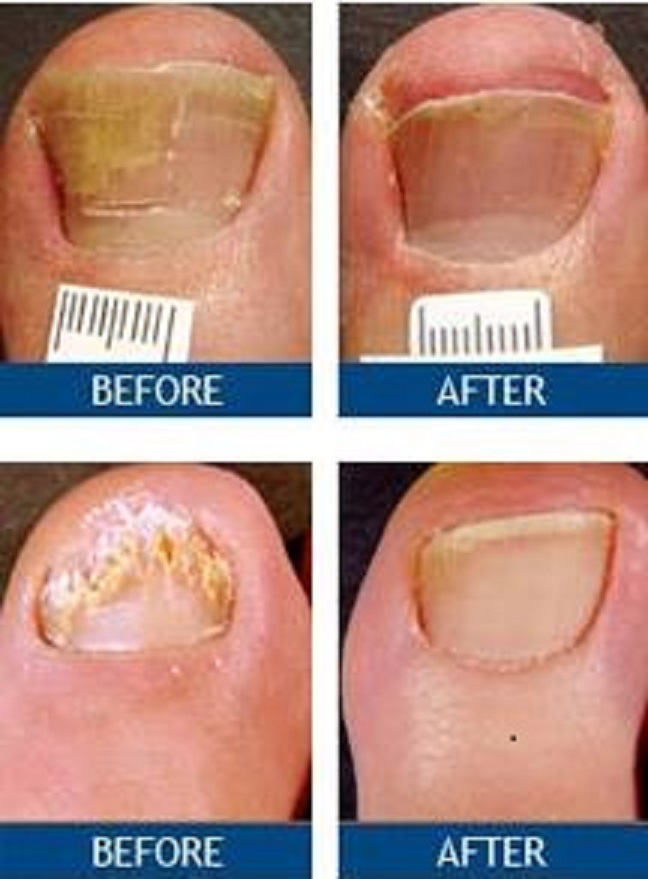 Laser Nail Therapy- Largest Toenail Fungus Treatment Center | 220A St Nicholas Ave Suite 718, Brooklyn, NY 11237, USA | Phone: (800) 672-0625