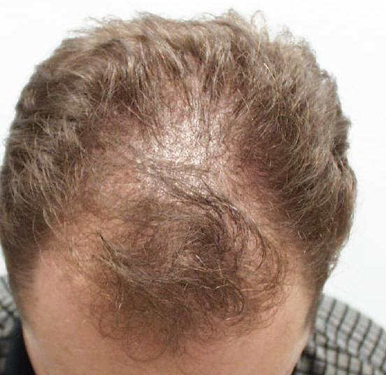 AZ Hair Restoration | 6400 Creedmoor Rd #104, Raleigh, NC 27613, USA | Phone: (919) 830-3778 AZ Hair Restoration | 6400 Creedmoor Rd #104, Raleigh, NC 27613, USA | Phone: (919) 830-3778