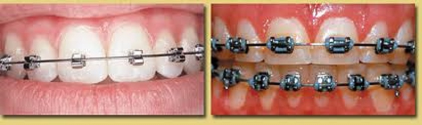 Blair Fadem, D.D.S. Orthodontics and Dentofacial Orthopedics | 735 E Ohio Ave STE 202, Escondido, CA 92025, USA | Phone: (760) 294-7450