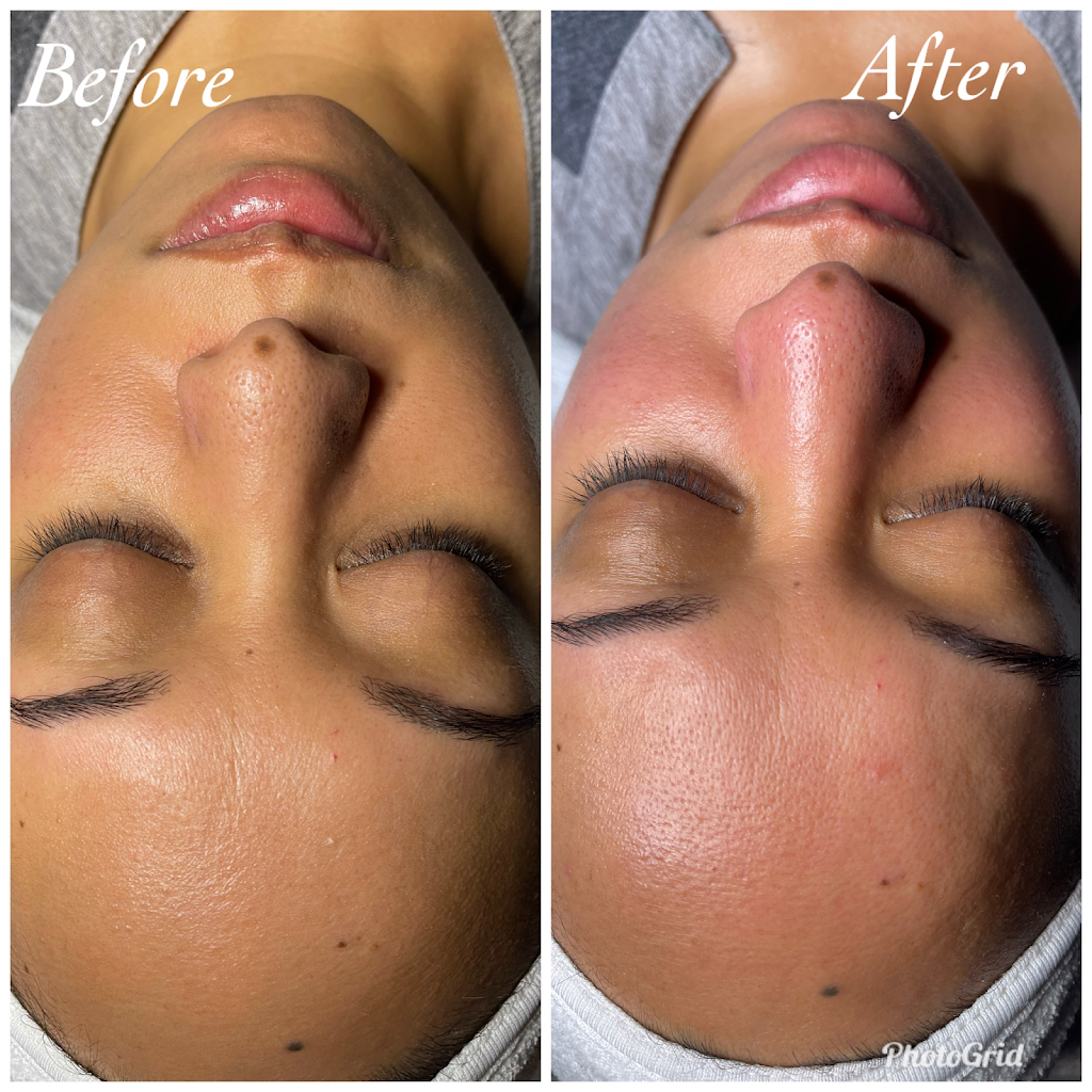 Elysian Skin & Acne Studio | Inside Legacy Salons & Spa, 420 E Round Grove Rd #200, Lewisville, TX 75067, USA | Phone: (214) 277-3888