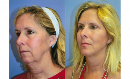 HANNA FACIAL COSMETIC SURGERY, LTD. | 950 N York Rd STE 201, Hinsdale, IL 60521, USA | Phone: (630) 552-6800