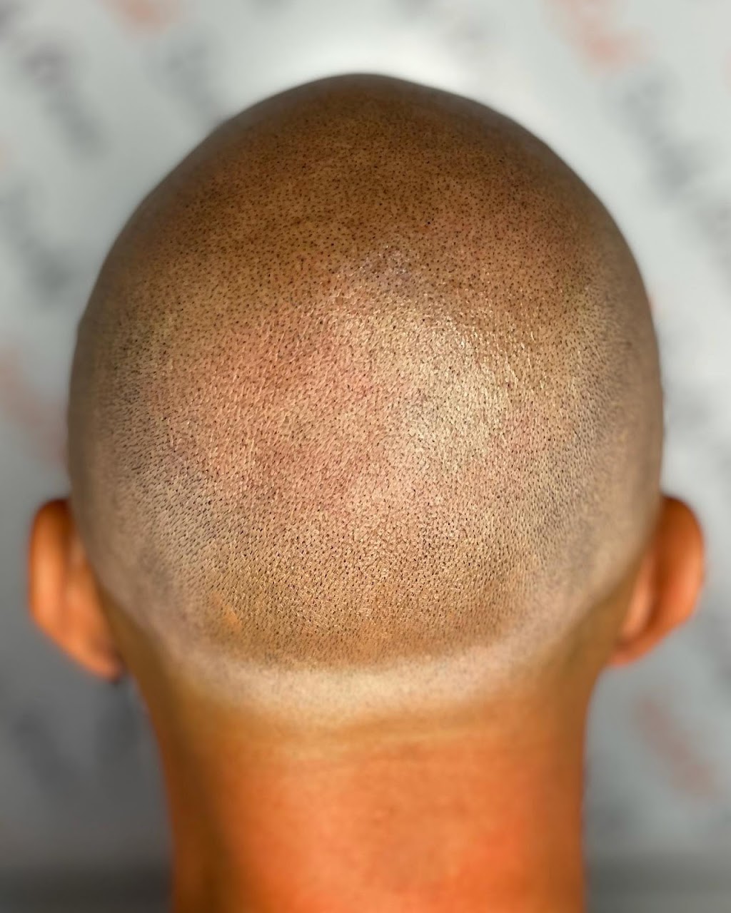 Scalp Mora Pigmentation | 1079 Lua Hala Canyon Rd, Vista, CA 92081 | Phone: (760) 583-4853