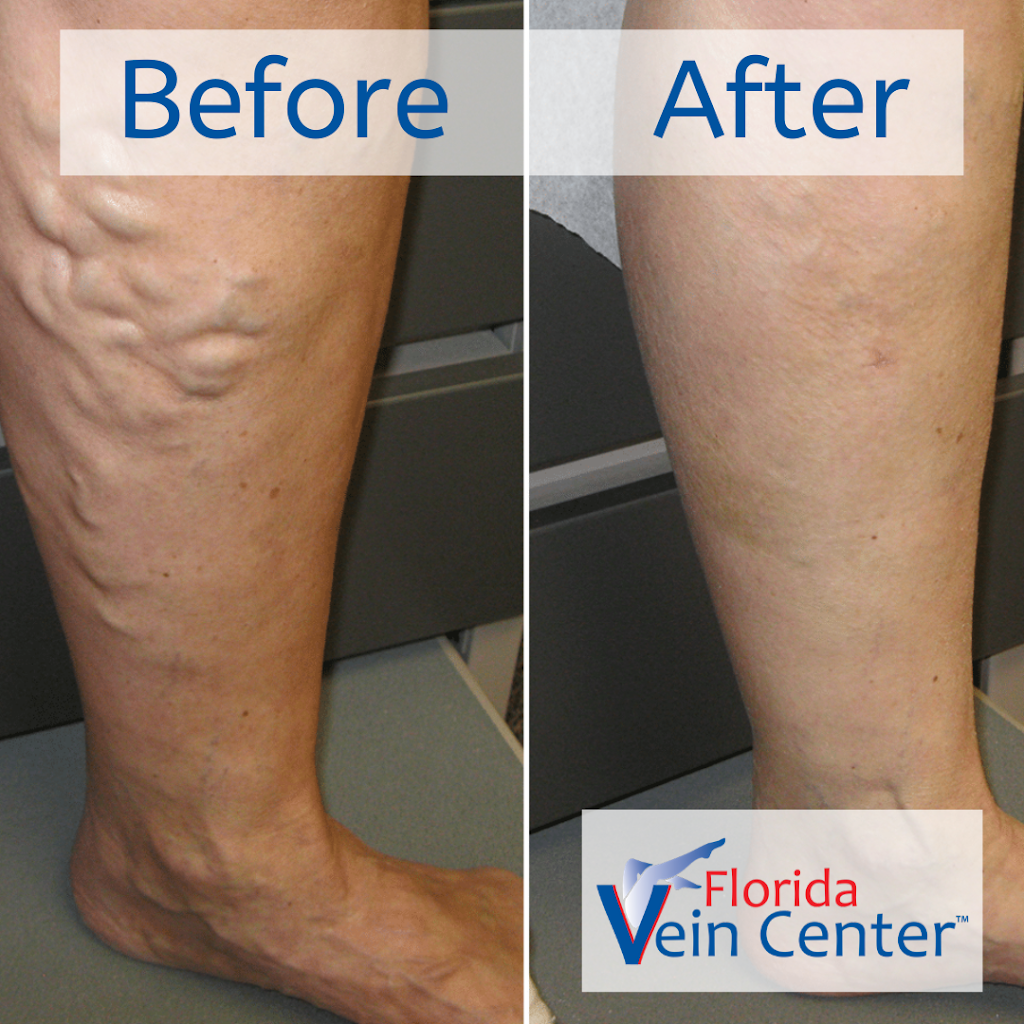 Florida Vein Center - Bradenton | 6050-A 53rd Ave E, Bradenton, FL 34203, USA | Phone: (941) 907-3400