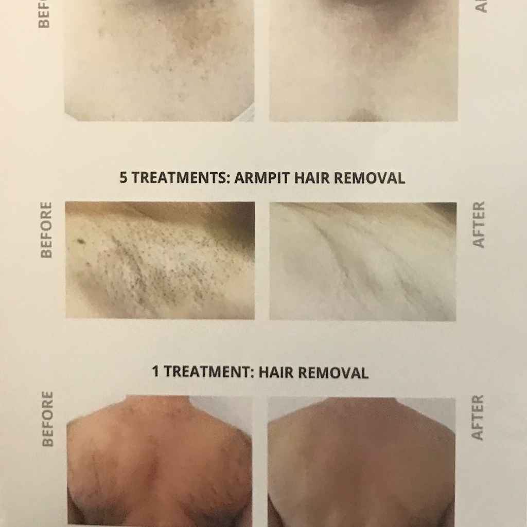 CR Electroloysis and Laser Hair Removal | 20 Pond Park Rd Suite 105, Hingham, MA 02043, USA | Phone: (781) 908-4502