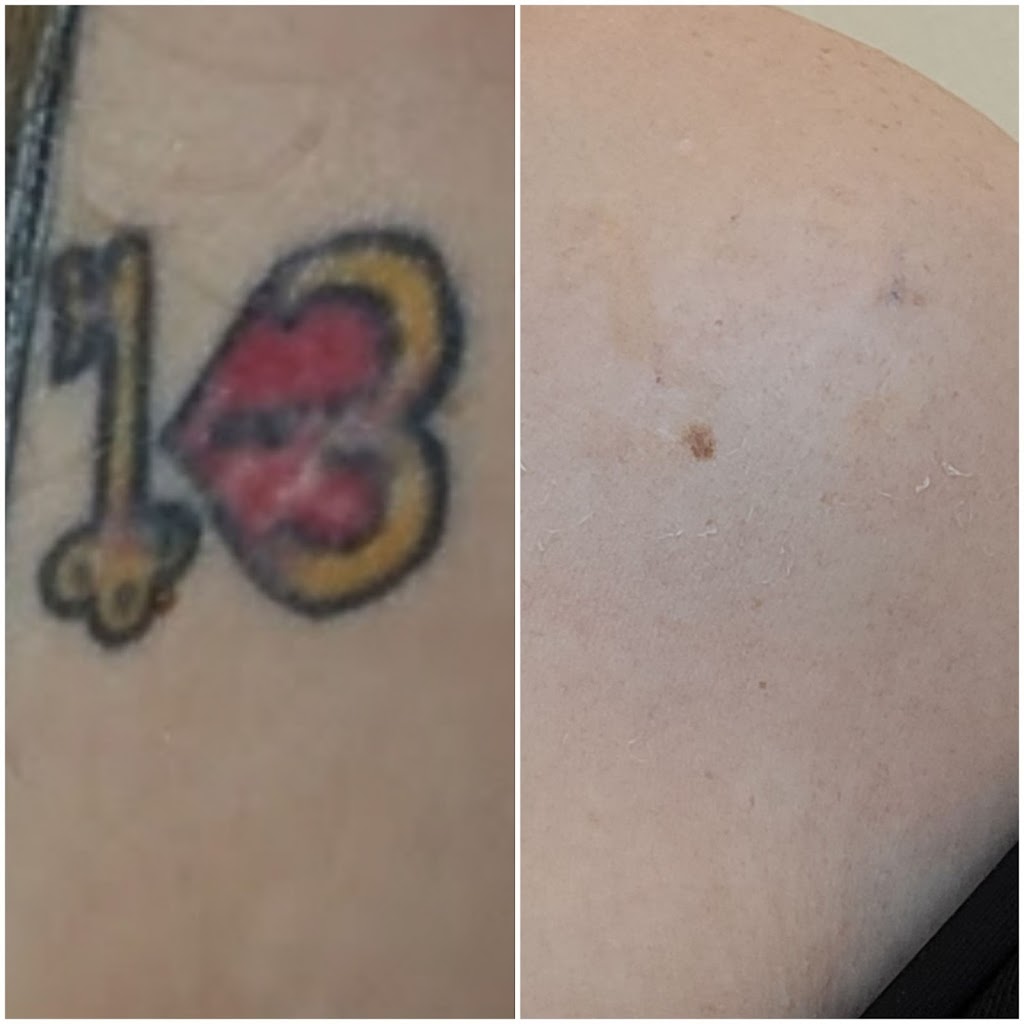 Vegas Laser Tattoo Removal | 8861 W Sahara Ave, Las Vegas, NV 89117, USA | Phone: (702) 869-6667