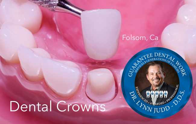 Lynn S. Judd DDS | 1568 Creekside Dr #101, Folsom, CA 95639, USA | Phone: (916) 983-1999