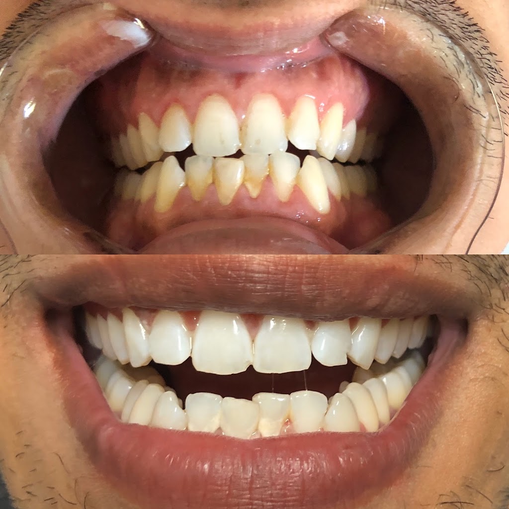 New Smiles Teeth Whitening | 222 Grifford Dr, Kissimmee, FL 34758, USA | Phone: (407) 279-0490