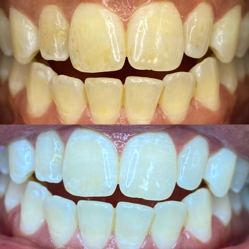 We Whiten Teeth Whitening | 7600 Denton Hwy Suite 101, Watauga, TX 76148, USA | Phone: (682) 334-3389