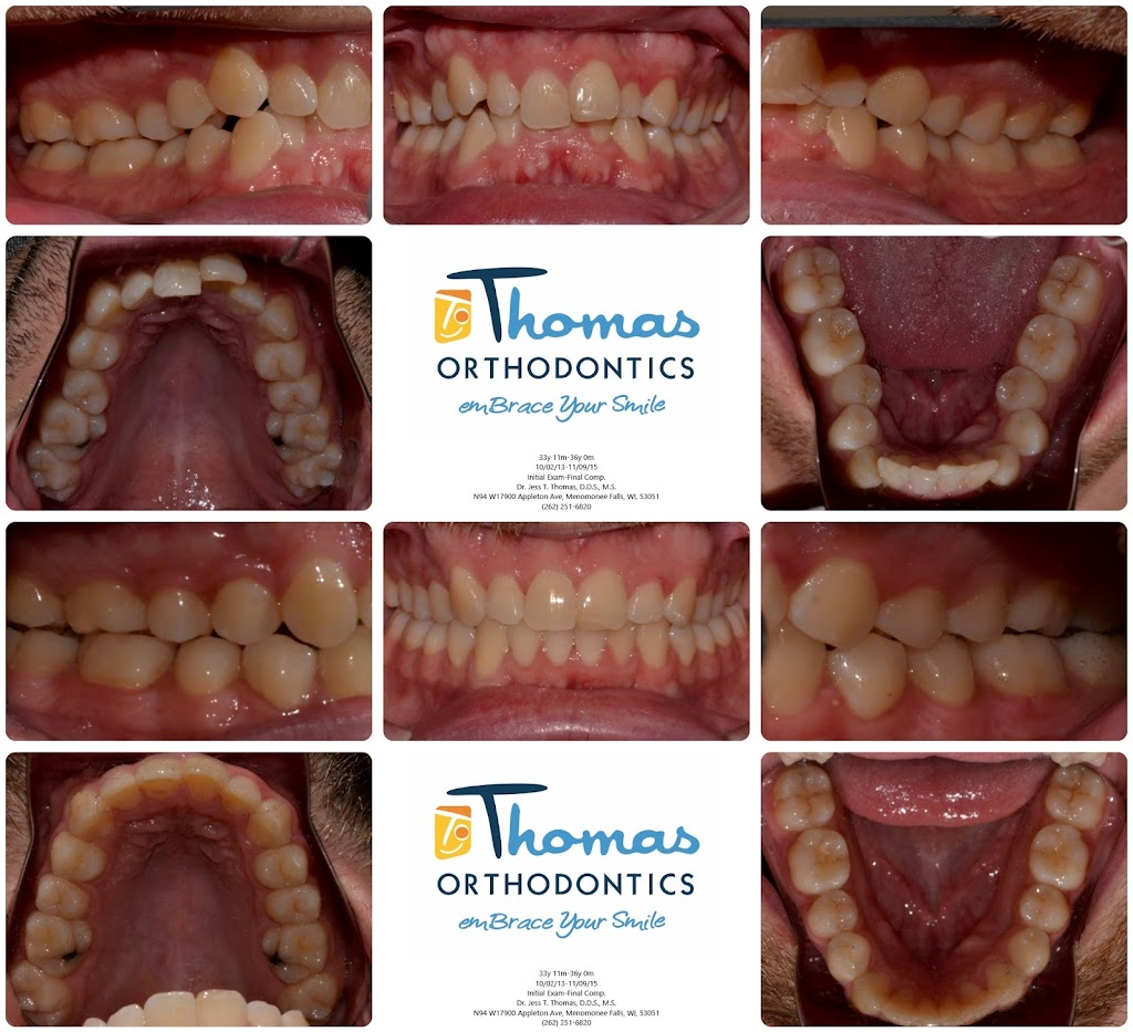 Thomas Orthodontics SC | 110 Pike Lake Dr, Hartford, WI 53027, USA | Phone: (262) 251-6820