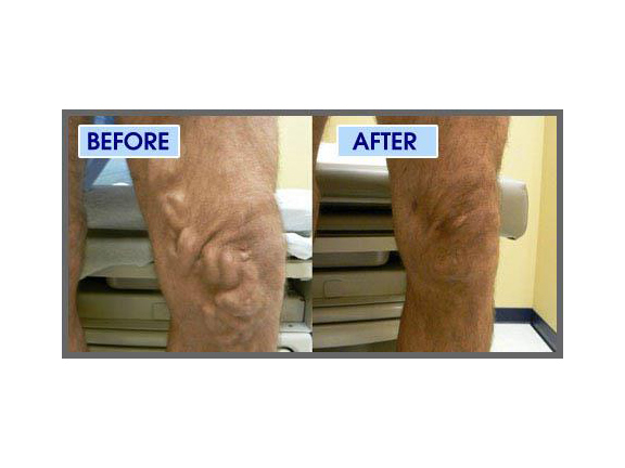 Vein Specialist of Northwest Georgia | 148 Bill Carruth Pkwy #380, Hiram, GA 30141, USA | Phone: (770) 423-0595