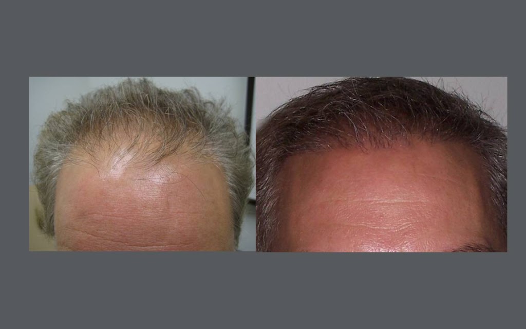 Buffalo Hair Transplant Center | 5007 Transit Rd Suite #2, Depew, NY 14043, USA | Phone: (716) 428-3998