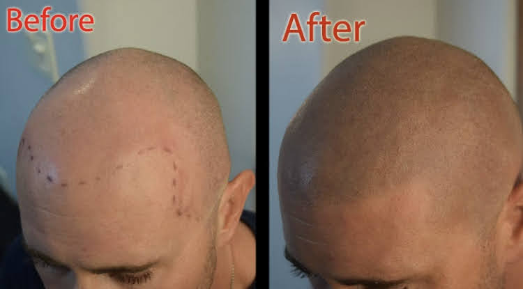 New You Ink Scalp Micropigmentation and Aesthetics | 1348 Sharon Copley Rd, Wadsworth, OH 44281, USA | Phone: (216) 626-5311