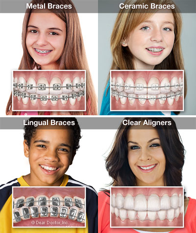 Hagler Orthodontics | 1290 N Monroe Dr, Xenia, OH 45385, USA | Phone: (937) 372-9279