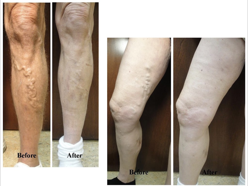 Indiana Vein & Laser Center: Marcus A. Jimenez MD, FACS | 7231 Engle Rd STE 100, Fort Wayne, IN 46804 | Phone: (260) 432-7654
