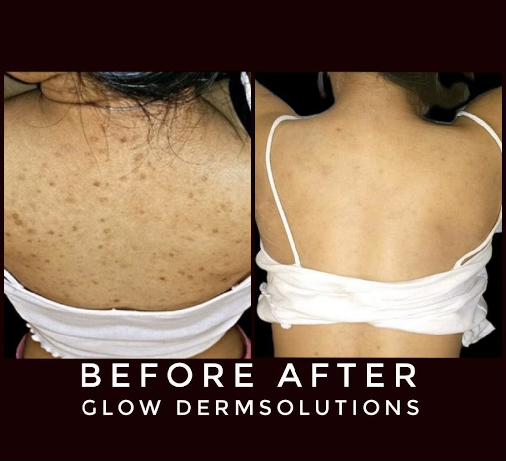 Glow DermSolutions San Jose | 6950 Santa Teresa Blvd STE E, San Jose, CA 95119, USA | Phone: (408) 794-5503 Glow DermSolutions San Jose | 6950 Santa Teresa Blvd STE E, San Jose, CA 95119, USA | Phone: (408) 794-5503