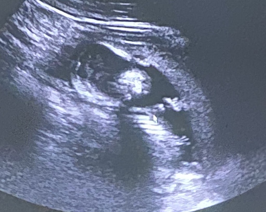 Love At First Sight 3D/4D HD Ultrasound | 3321 Colorado Blvd, Denton, TX 76210, USA | Phone: (940) 727-1272