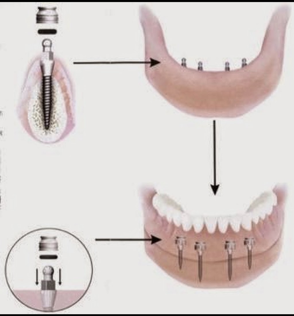 Mini Dental Implant Center | 120 Carter Blvd Suite 8, Polk City, FL 33868, USA | Phone: (863) 984-0000