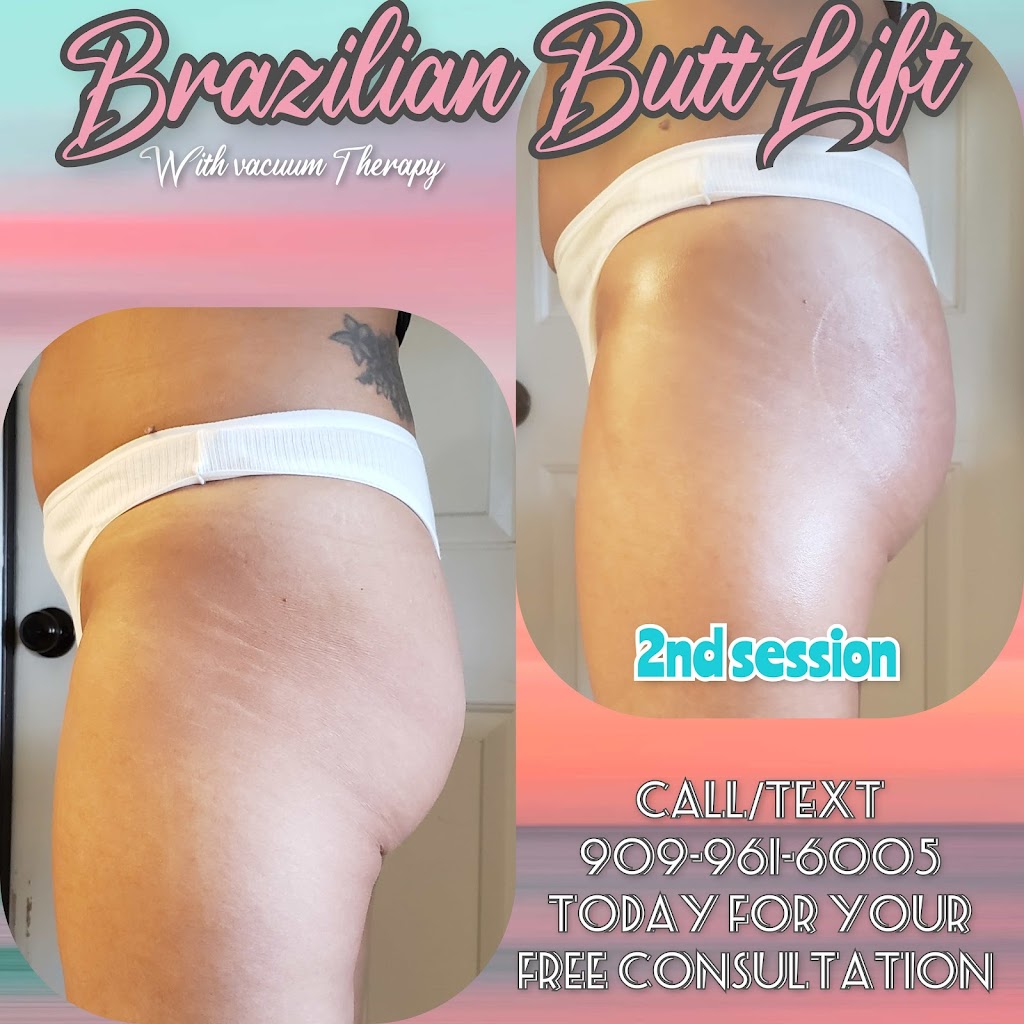 Pure Sass Body Contouring | 34265 Yucaipa Blvd, Yucaipa, CA 92399, USA | Phone: (909) 961-6005