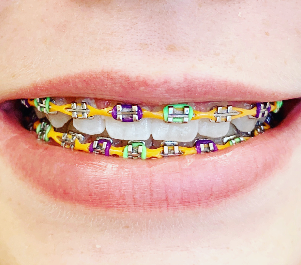 Koerich Orthodontics | 6437 Old Monroe Rd Suite H, Indian Trail, NC 28079, USA | Phone: (980) 202-7444