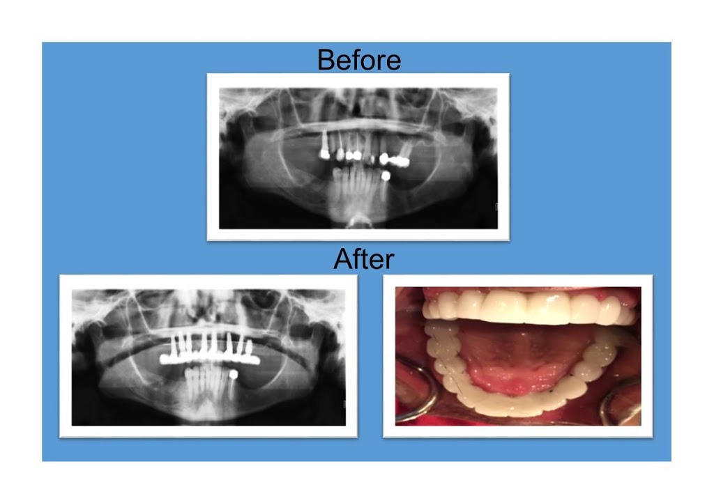 Dental Implant Institute | 6170 W Desert Inn Rd, Las Vegas, NV 89146, USA | Phone: (702) 936-6814