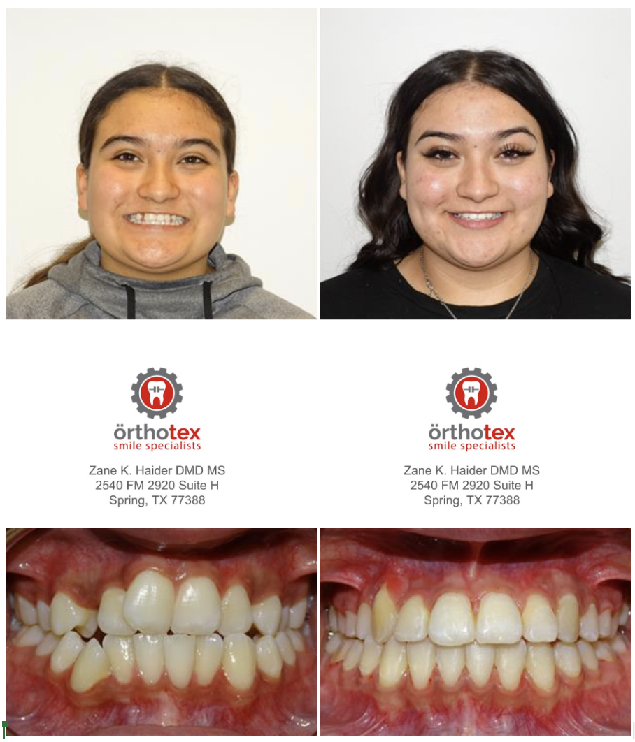 Orthotex Smile Specialists | 2540 Farm to Market 2920, Spring, TX 77388, USA | Phone: (281) 937-2540
