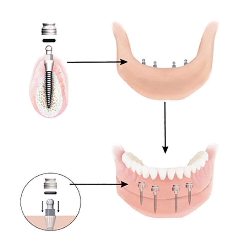 Dental Implant Solutions of Wichita KS | 710 N Woodchuck St, Wichita, KS 67212, USA | Phone: (316) 789-6556