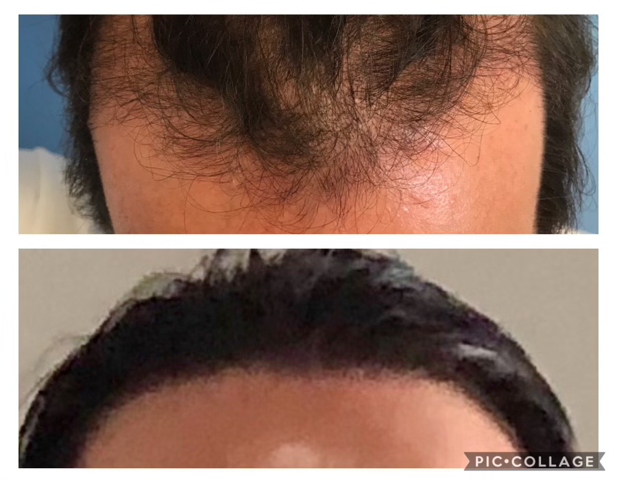 Neograft Hair Restoration Orange County | 400 Newport Center Dr Suite 100A, Newport Beach, CA 92660 | Phone: (949) 644-1641