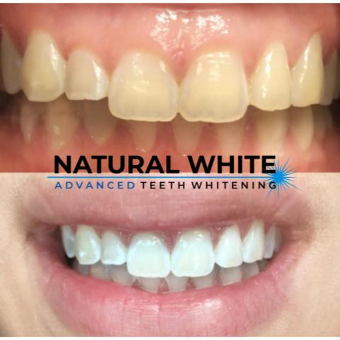 Natural White Clinical Teeth Whitening | 2993 Sandy Plains Rd Suite 125 Office 4, Marietta, GA 30066, USA | Phone: (704) 966-9090