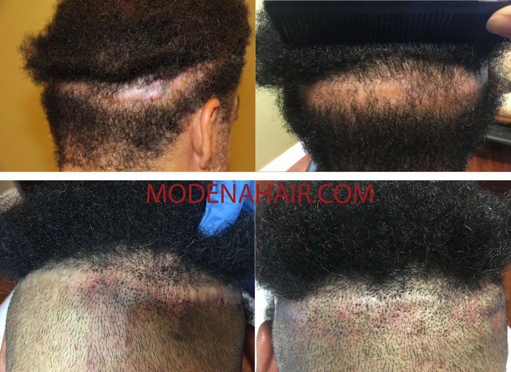 Modena Hair Transplant Institute | 2629 W Horizon Ridge Pkwy Suite #110, Henderson, NV 89052, USA | Phone: (702) 966-5134 Modena Hair Transplant Institute | 2629 W Horizon Ridge Pkwy Suite #110, Henderson, NV 89052, USA | Phone: (702) 966-5134