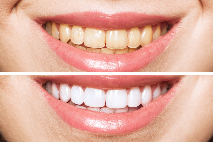 Smiles By Morel | 5501 Independence Pkwy #205, Plano, TX 75023, USA | Phone: (972) 398-0020