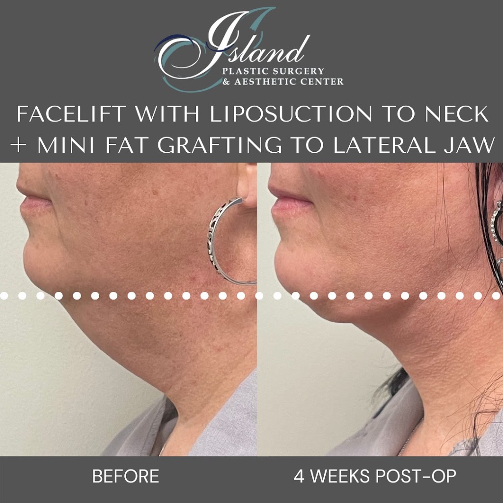 Island Plastic Surgery | 190 E Jericho Turnpike Suite 202, Mineola, NY 11501, USA | Phone: (516) 977-9922