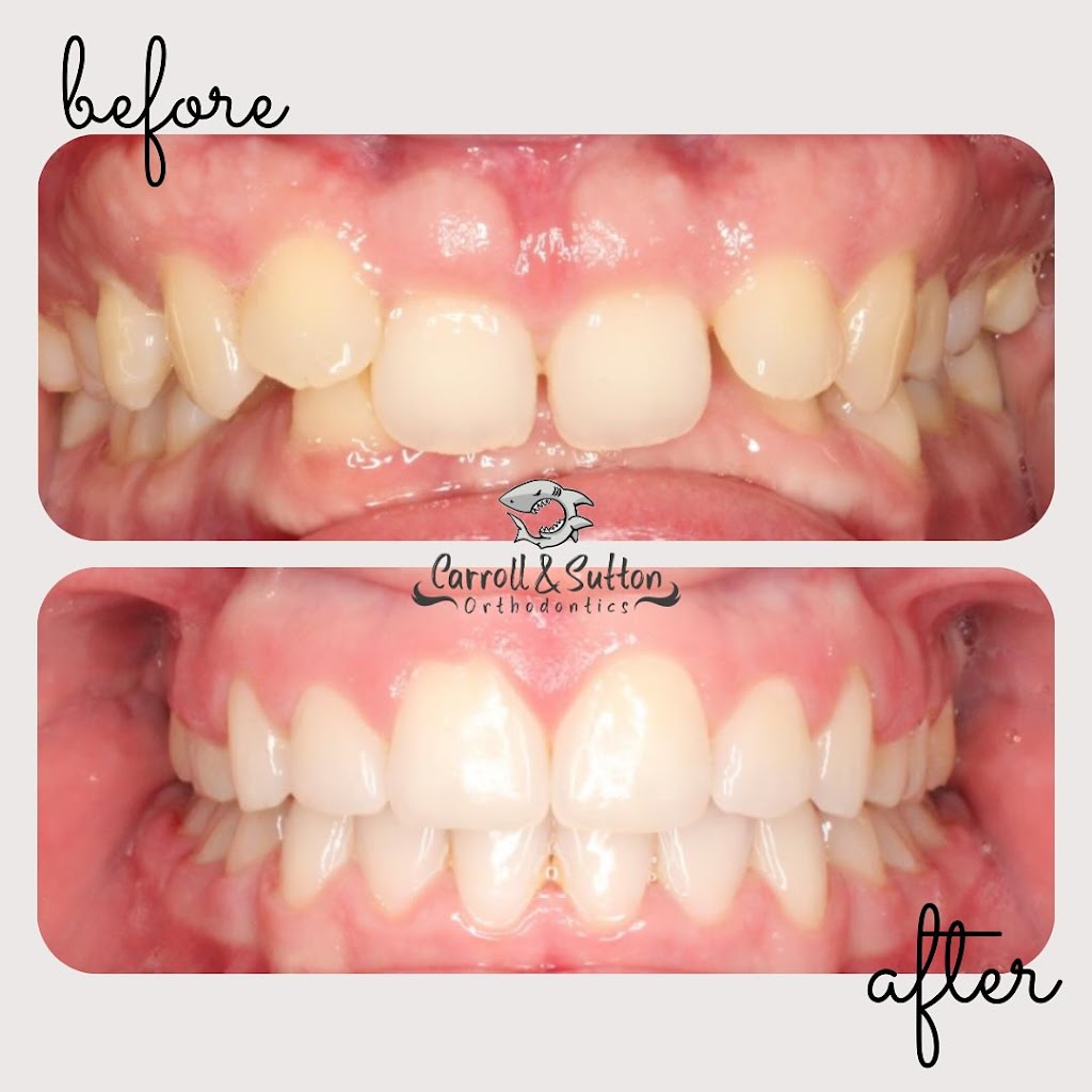 Carroll & Sutton Orthodontics | 8208 Tourist Center Dr, Bradenton, FL 34201, USA | Phone: (941) 366-1612
