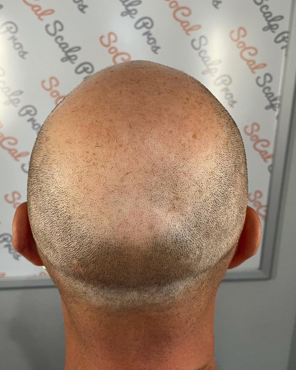 Scalp Mora Pigmentation | 1079 Lua Hala Canyon Rd, Vista, CA 92081 | Phone: (760) 583-4853