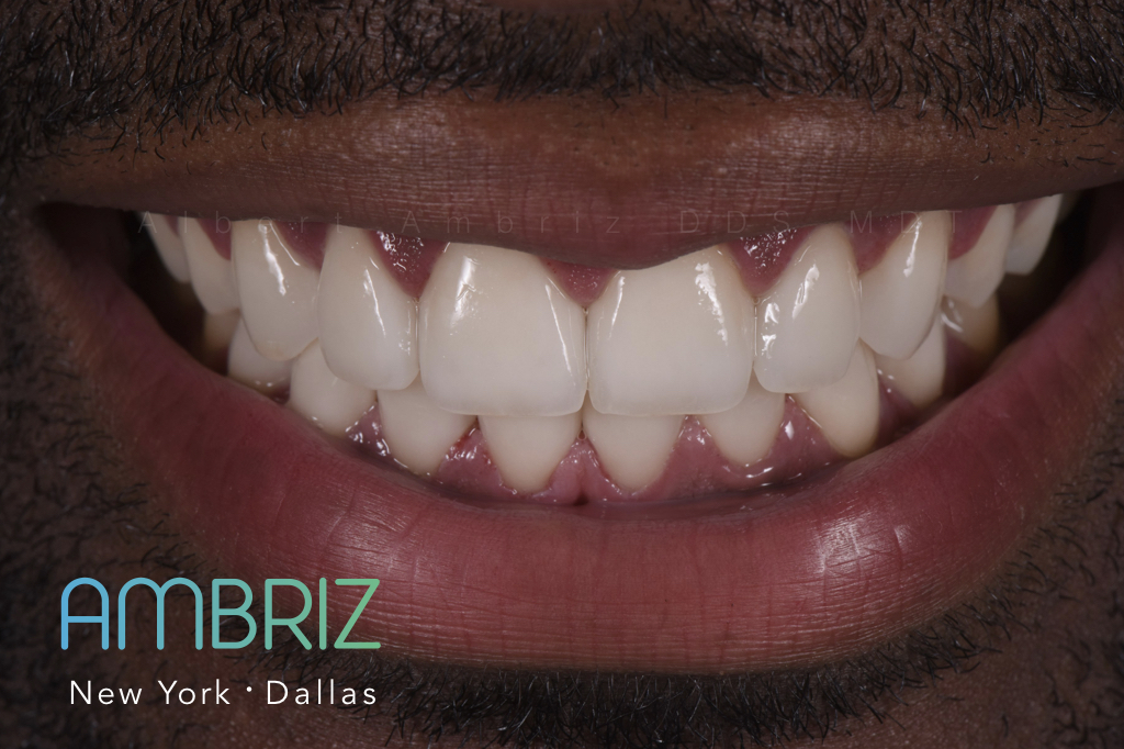 Ambriz Dental | 9400 N US 75-Central Expy 1000 Suite #220, Dallas, TX 75231, USA | Phone: (214) 368-0514