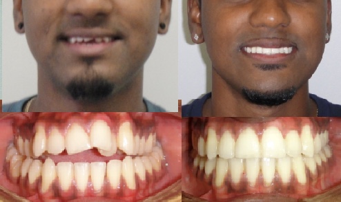 iCare Orthodontics | 97-16 Metropolitan Ave, Queens, NY 11375, USA | Phone: (718) 846-4400