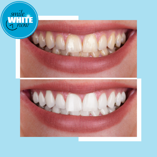 Smile White Now | 5850 Eubank Blvd NE Suite B42, Albuquerque, NM 87111, USA | Phone: (505) 508-5377