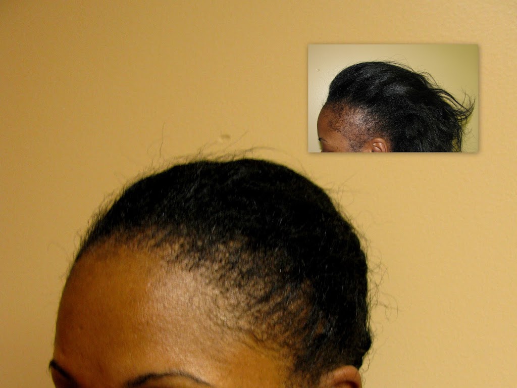 Raleigh Hair Transplants | 5520 McNeely Dr #203, Raleigh, NC 27612, USA | Phone: (919) 787-2401