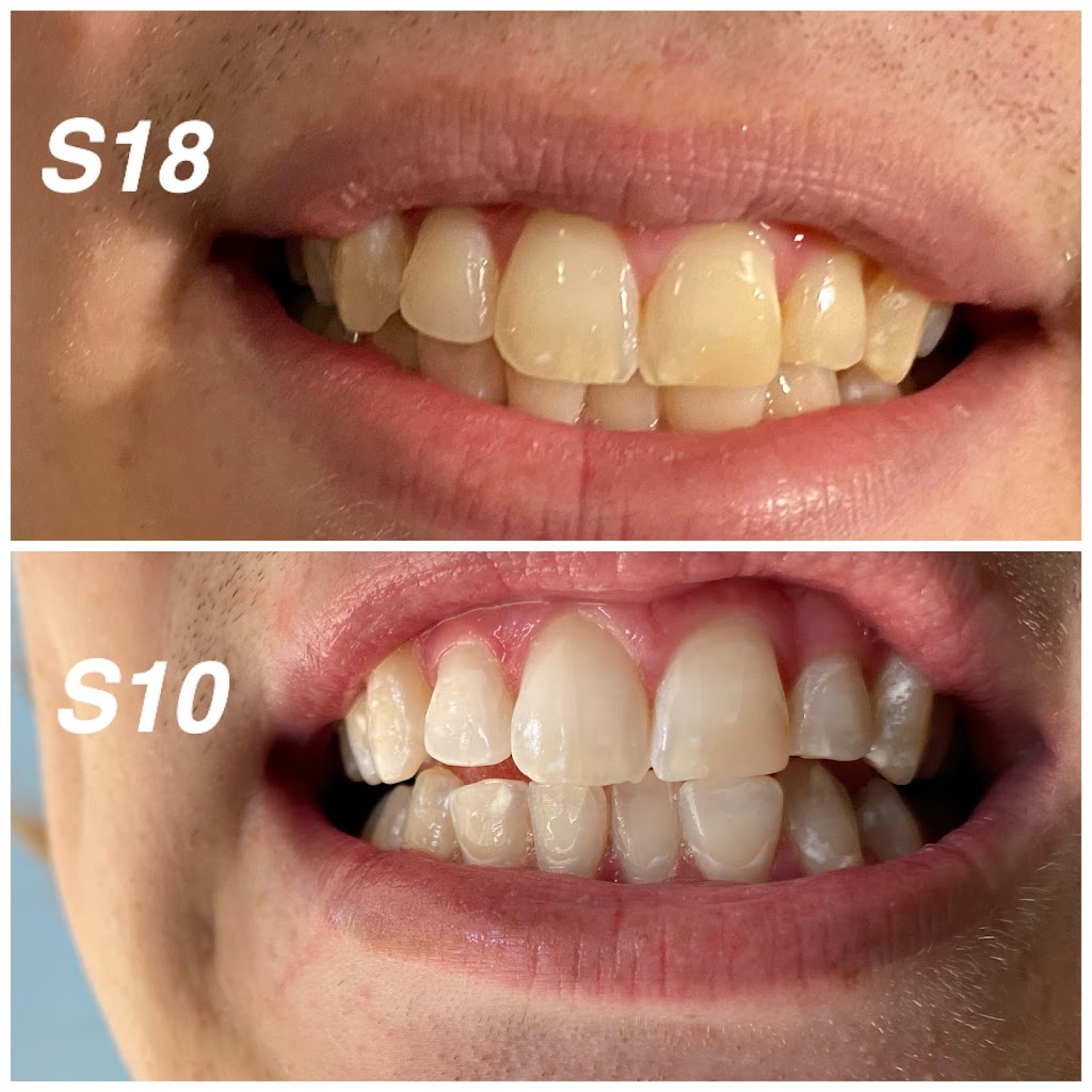 Whoa Whitening | 2187 Sharon Rd, Cumming, GA 30041, USA | Phone: (470) 495-6059