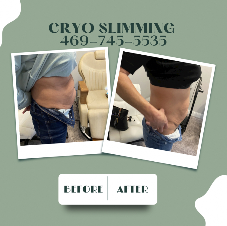 Cryo Rejuvenation | 1741 Bertino Way, Rockwall, TX 75032, USA | Phone: (469) 745-5535