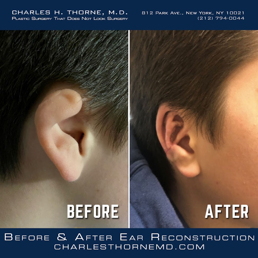 Charles H. Thorne, M.D. Plastic Surgeon | 812 Park Ave, New York, NY 10021, USA | Phone: (212) 794-0044