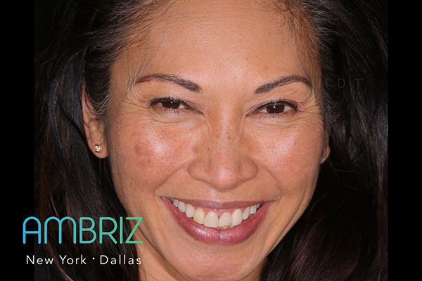 Ambriz Dental | 9400 N US 75-Central Expy 1000 Suite #220, Dallas, TX 75231, USA | Phone: (214) 368-0514