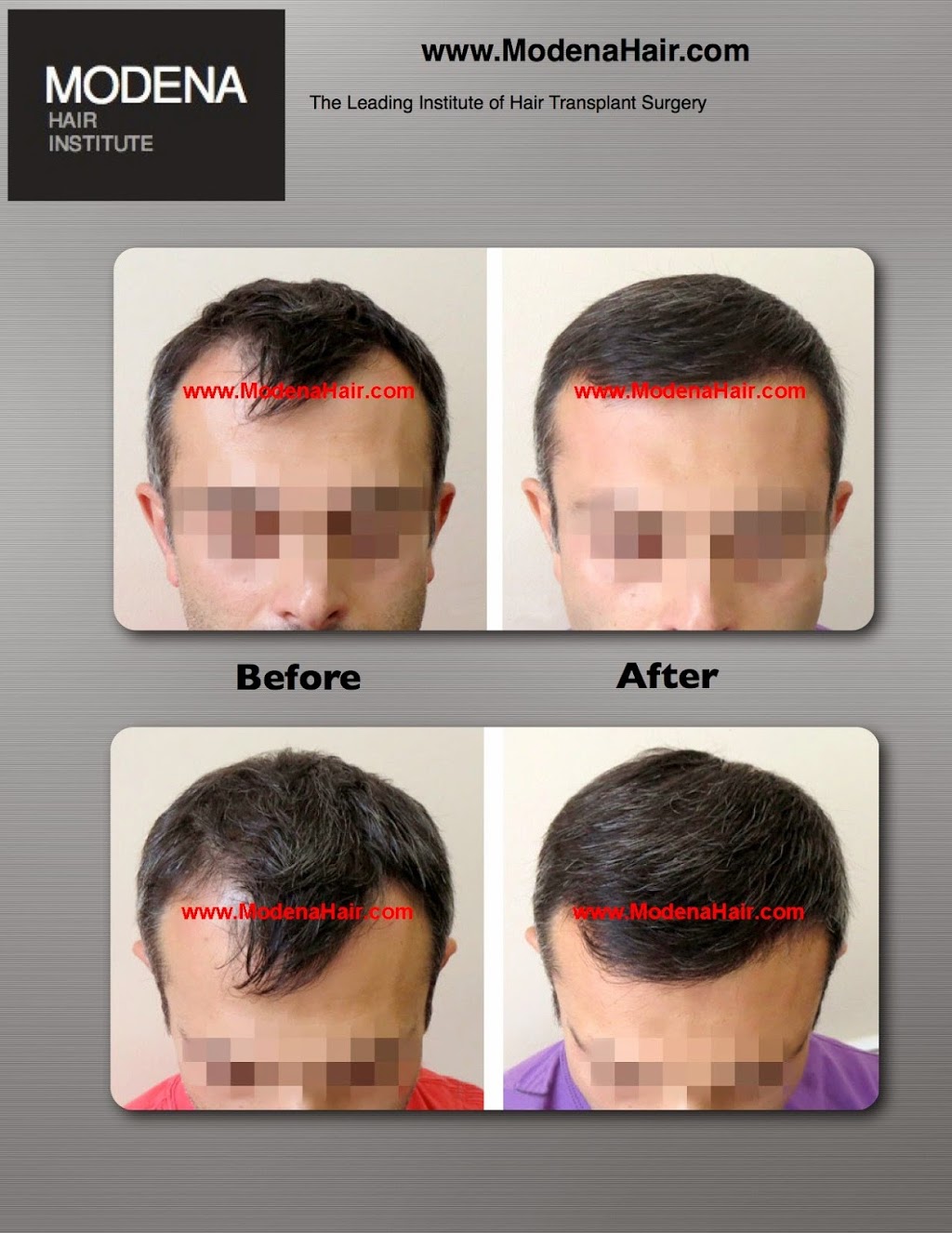 Modena Hair Transplant Institute | 2629 W Horizon Ridge Pkwy Suite #110, Henderson, NV 89052, USA | Phone: (702) 966-5134 Modena Hair Transplant Institute | 2629 W Horizon Ridge Pkwy Suite #110, Henderson, NV 89052, USA | Phone: (702) 966-5134