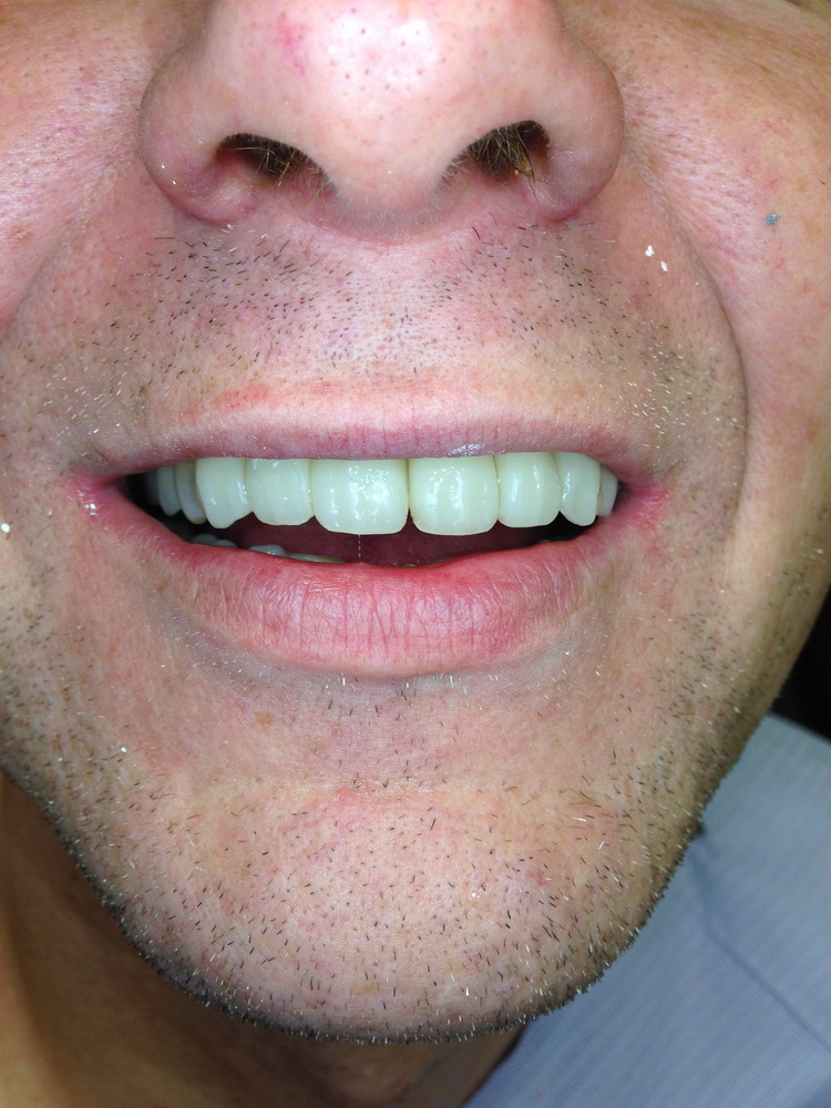 Veneers Teeth NJ | 70 Spruce St suite 35, Paterson, NJ 07501, USA | Phone: (862) 777-9424