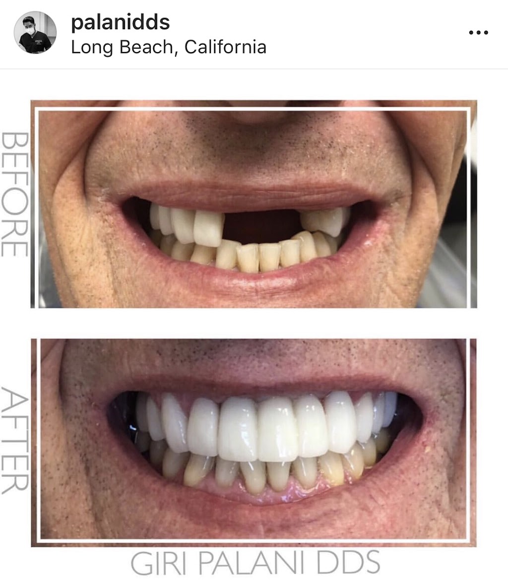 Palani Center For Dental Implants | 28358 S Western Ave, Rancho Palos Verdes, CA 90275, USA | Phone: (213) 725-2086