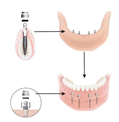 Dental Implant Solutions Raleigh, NC | 5613 Duraleigh Rd #131a, Raleigh, NC 27612, USA | Phone: (919) 374-8494