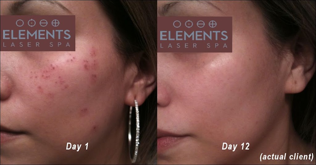 Elements Laser Spa | 1870 Keller Pkwy, Keller, TX 76248, USA | Phone: (817) 741-5242