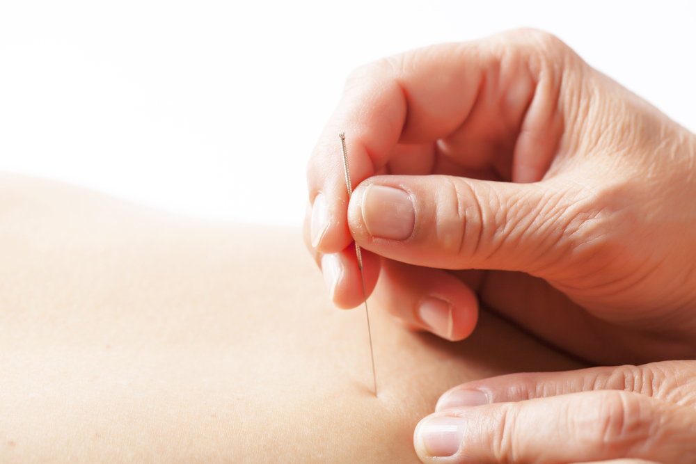 Renew You Acupuncture | 13754 Frontier Ct #102, Burnsville, MN 55337, USA | Phone: (612) 751-3717